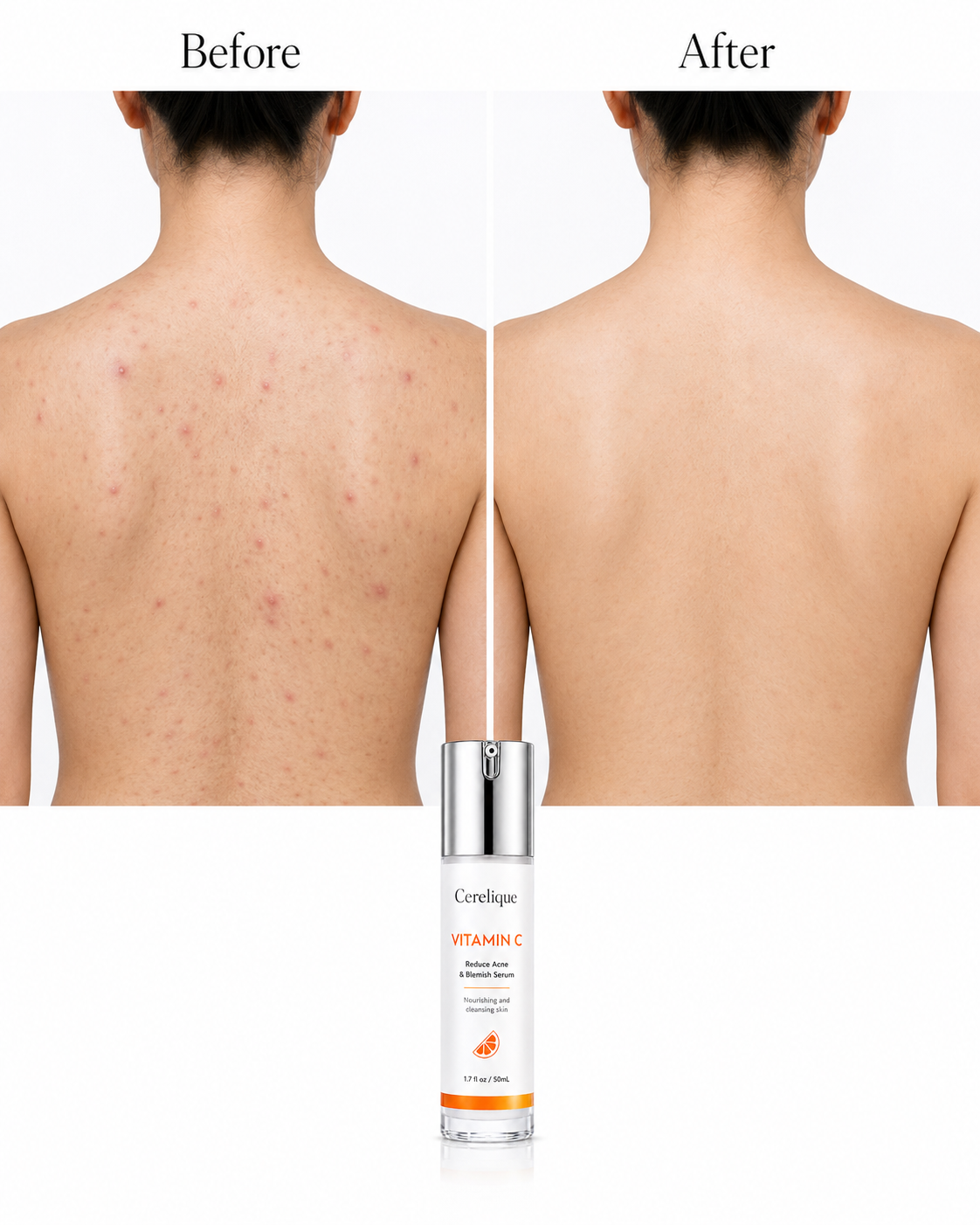 Acne Nursing Cream Moisturizes Skin