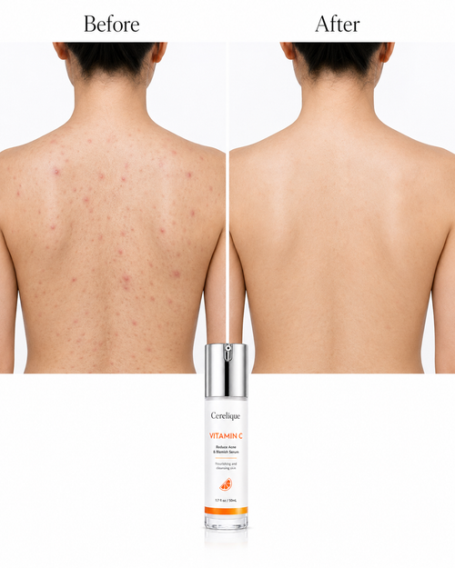 Acne Nursing Cream Moisturizes Skin