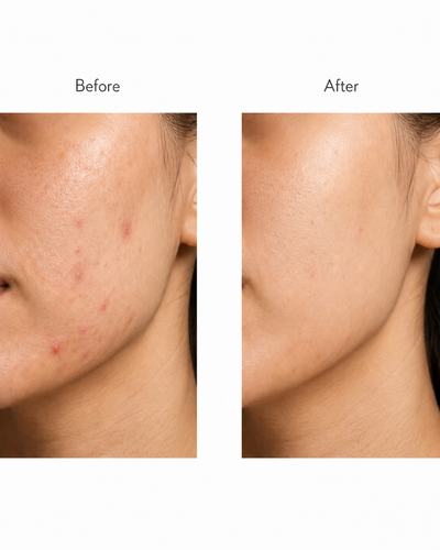 Acne Nursing Cream Moisturizes Skin