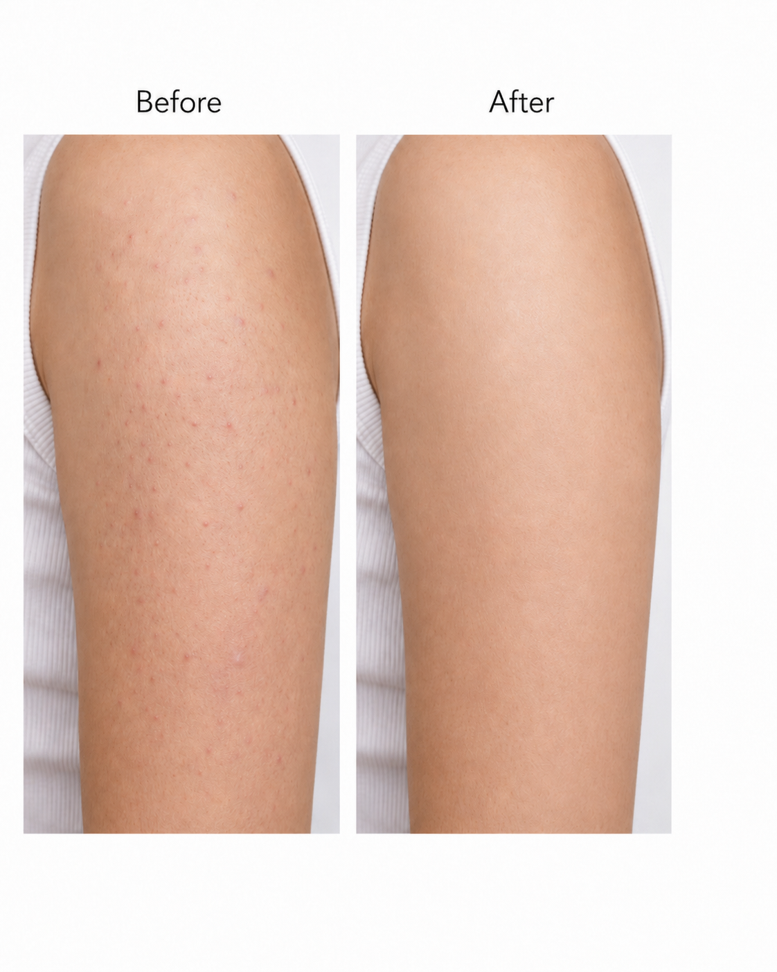 Acne Nursing Cream Moisturizes Skin