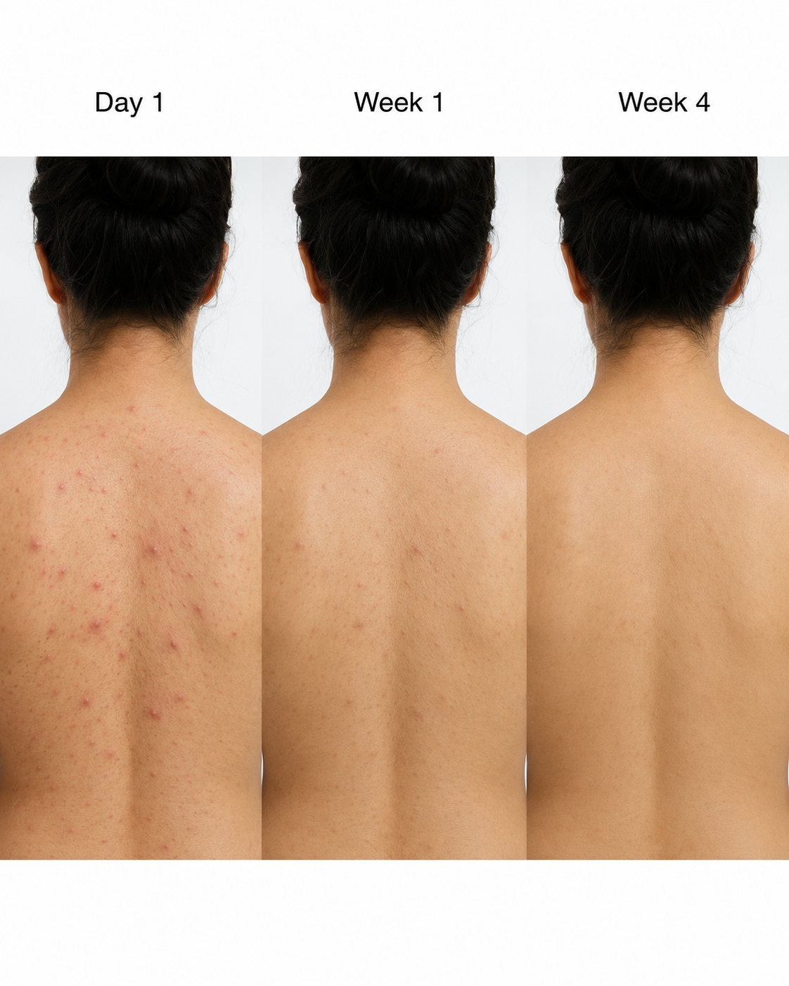 Acne Nursing Cream Moisturizes Skin