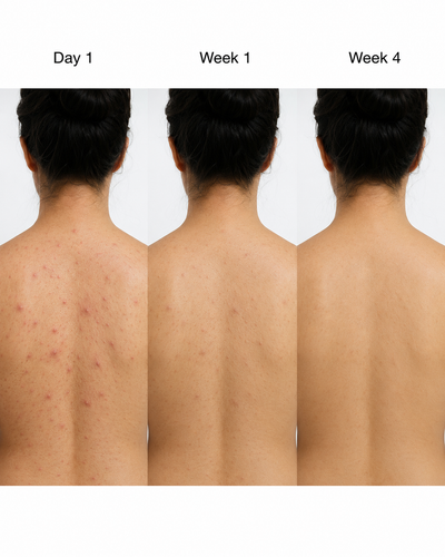 Acne Nursing Cream Moisturizes Skin
